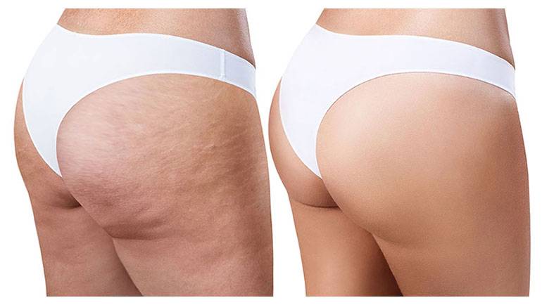 LPG cellulite before and after