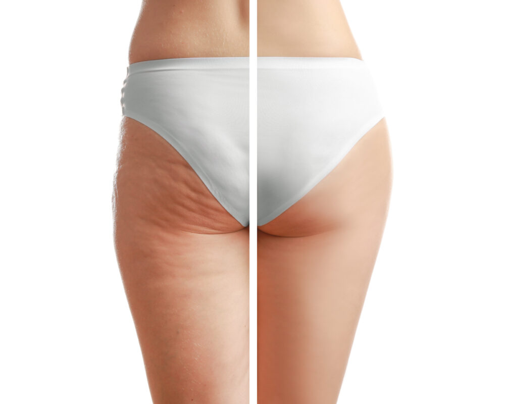 LPG endermologie sessions for results