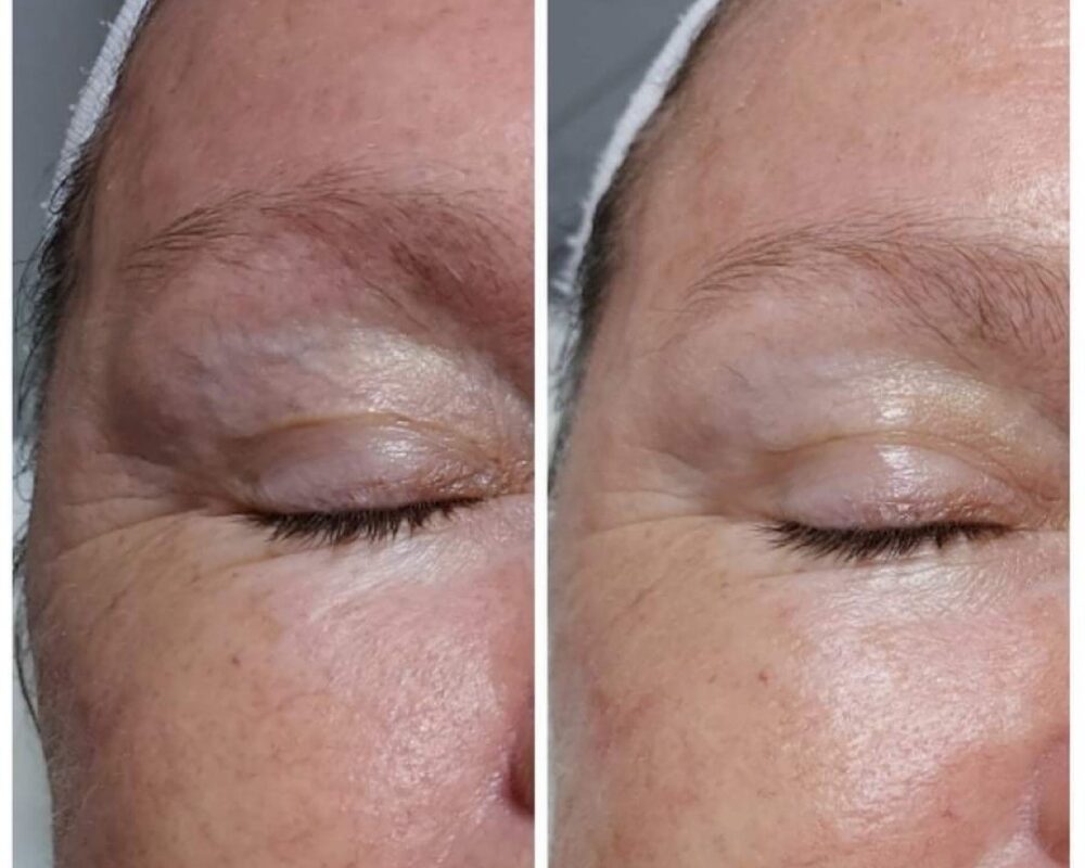 Non Surgical Facelift Before and after comparison