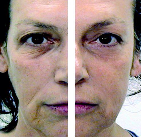 non surgical facelift side-by-side